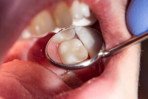 Restoration of the chewing surface with a photopolymer filling material